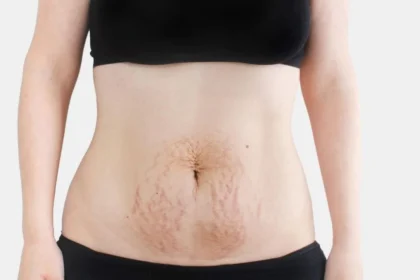 Diastasis Recti Recovery Without Surgery
