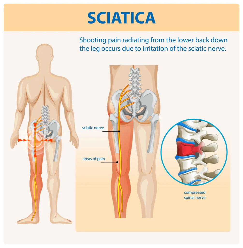 Can Sciatica Go Away on Its Own
