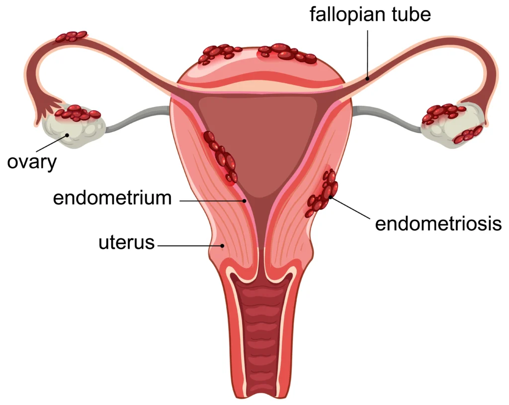 Physiotherapy for Endometriosis Pain