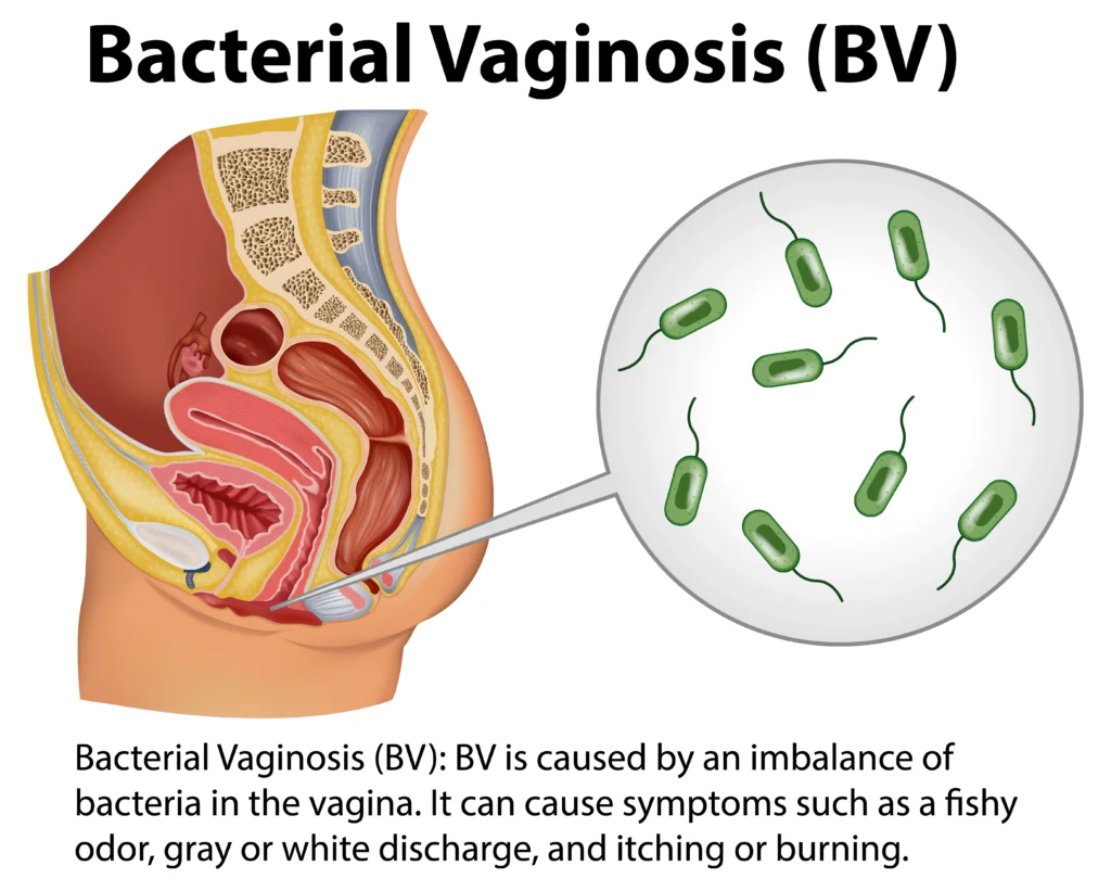 Bacterial Vaginosis Symptoms