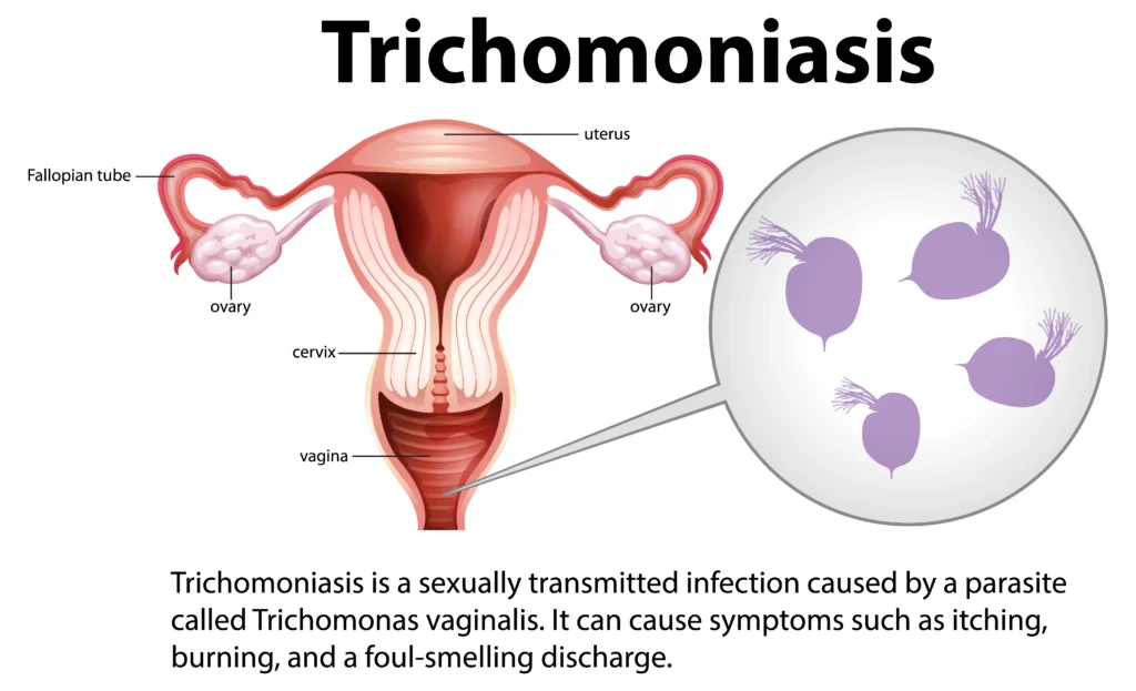 Trichomoniasis Treatment