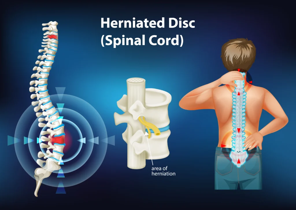 Bulging Disc vs Herniated Disc