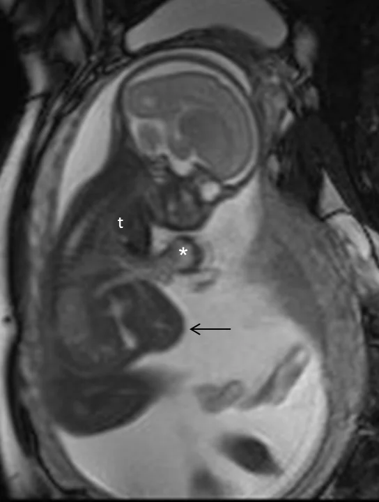 Fetal MRI During Pregnancy