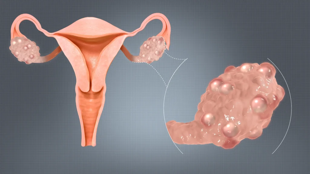 Treatment for Ovarian Cysts