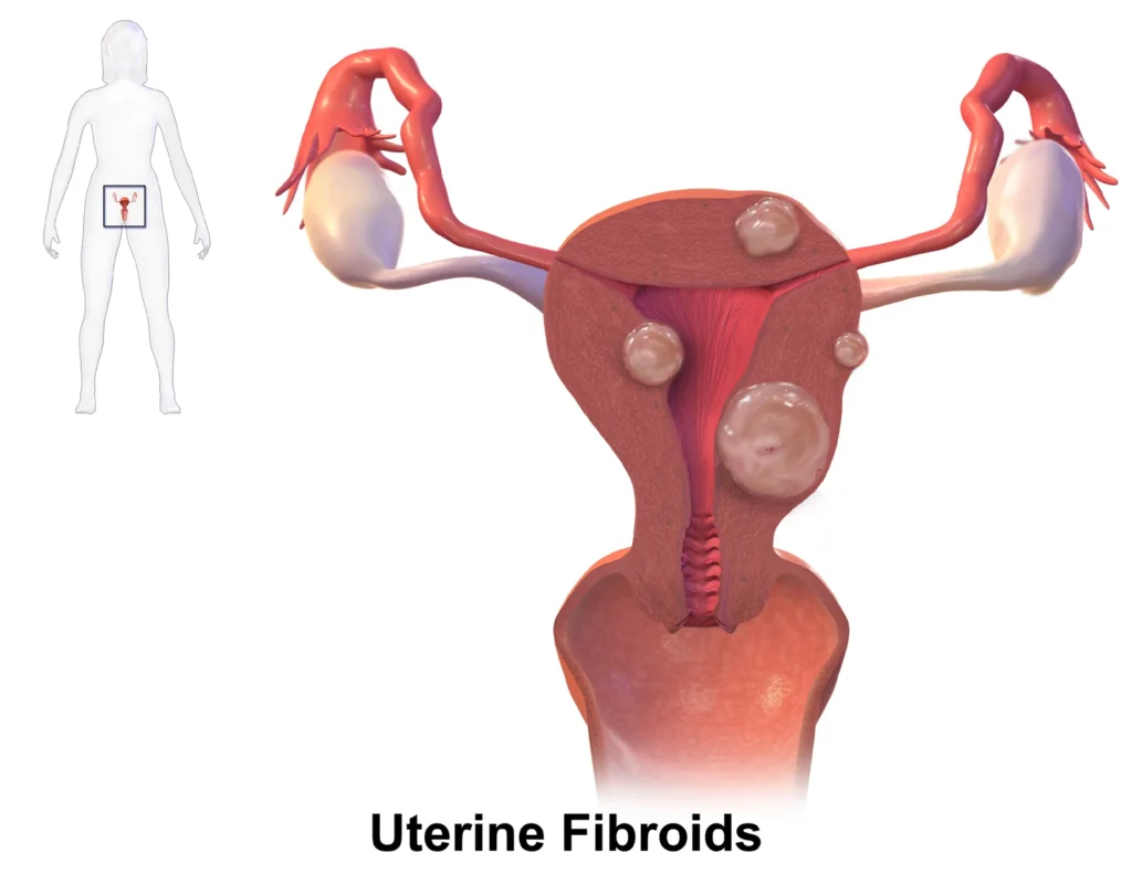 Uterine Fibroids Treatment