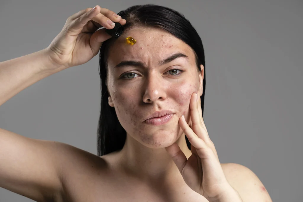 PCOS and Oily Skin