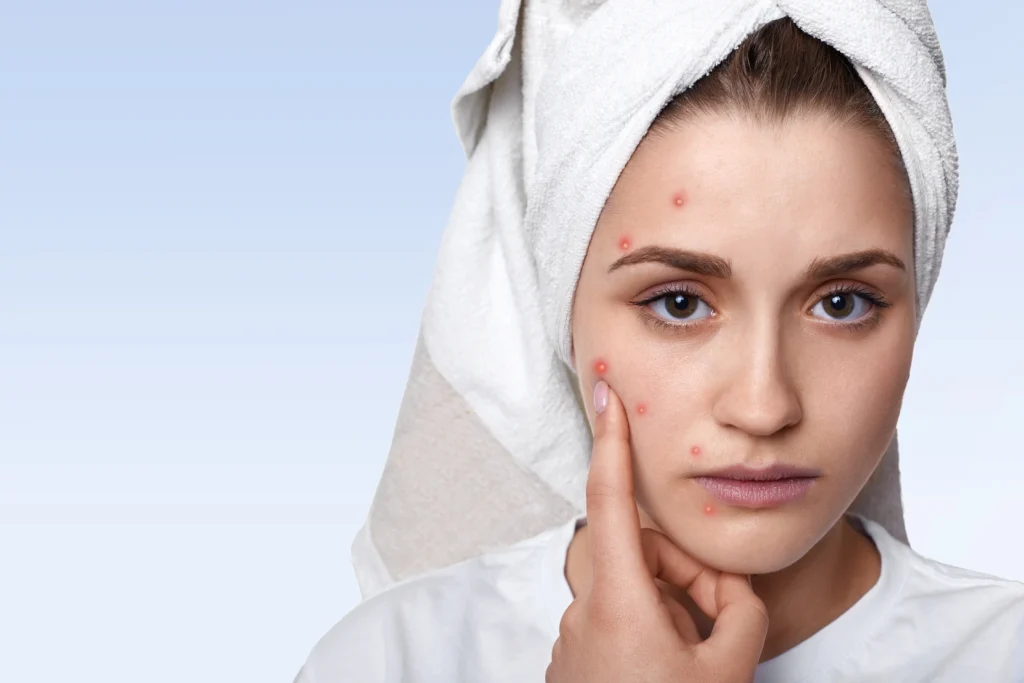 PCOS Acne Treatment