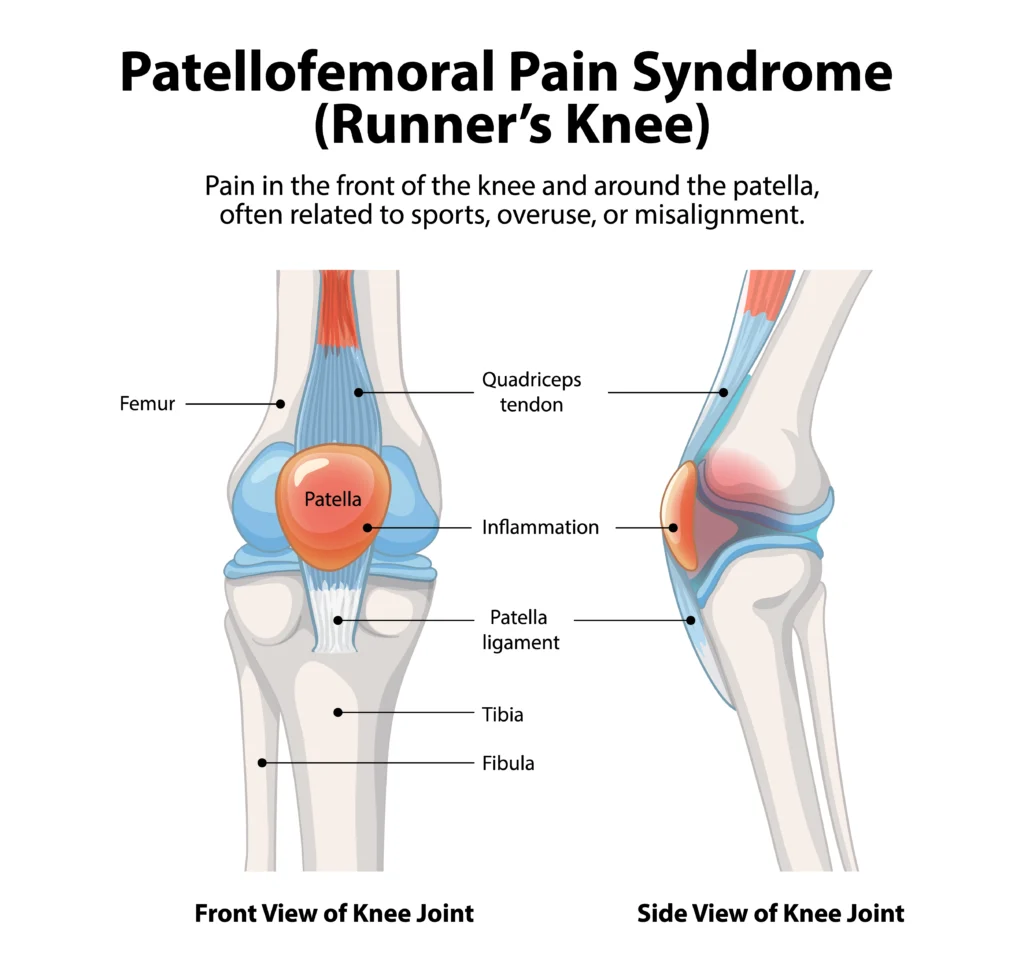 patellofemoral pain syndrome treatment