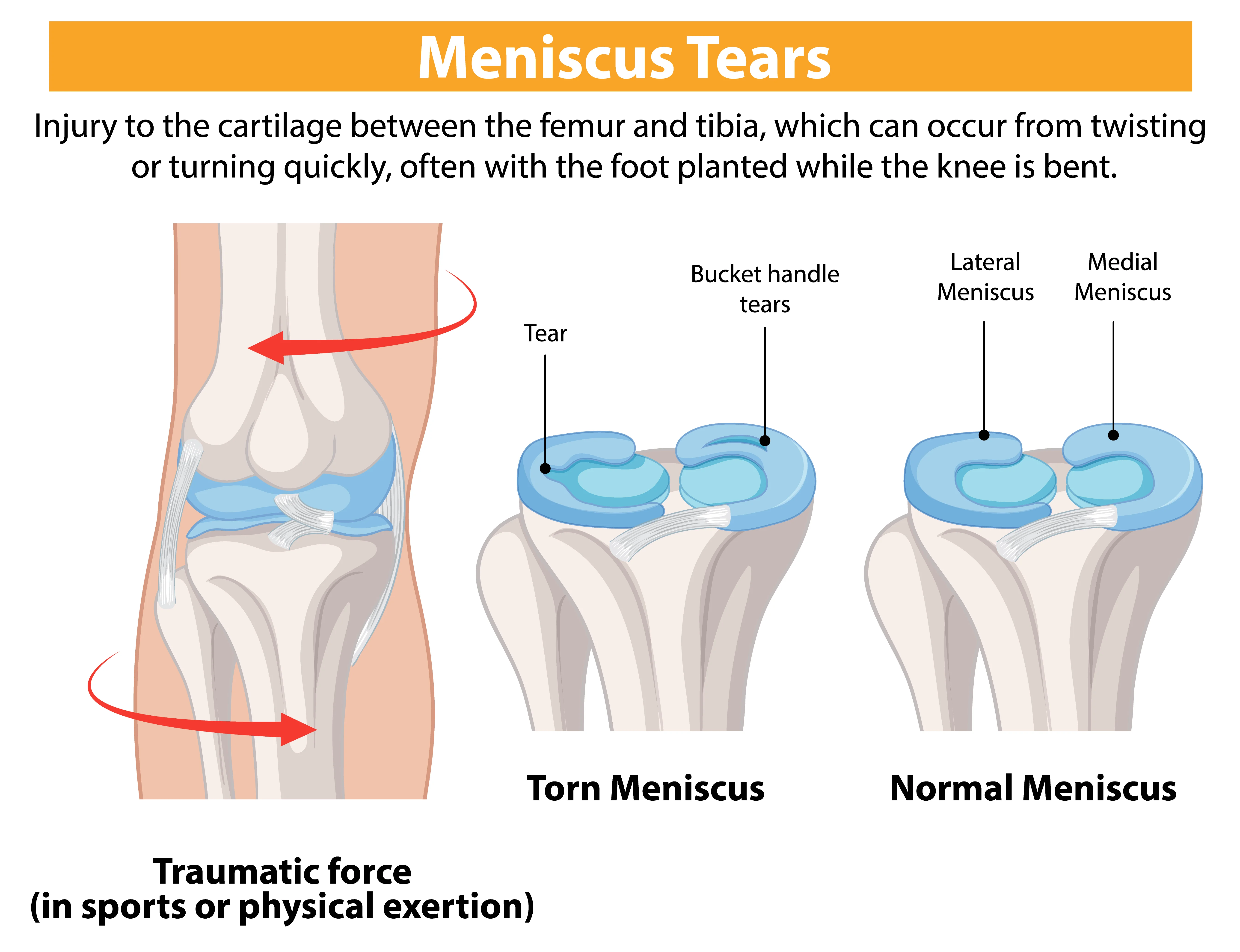 treatment for meniscus tear