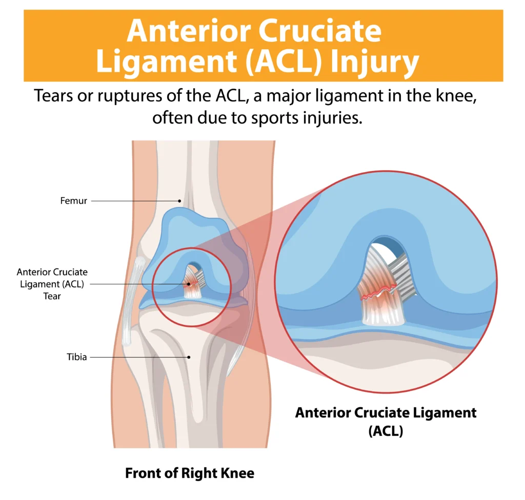 ACL tear recovery