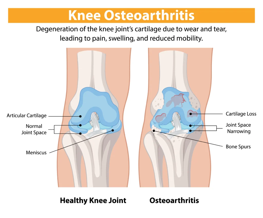 How to slow knee osteoarthritis