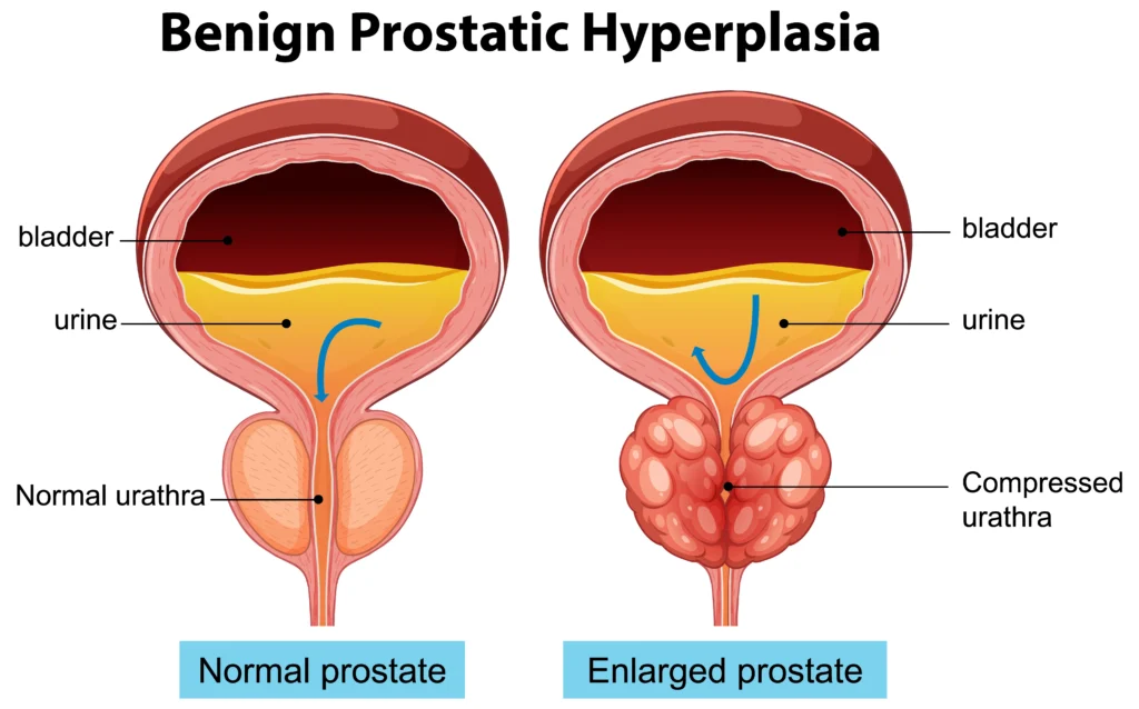 benign prostatic hyperplasia