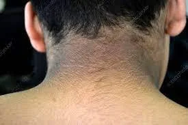 Dark Skin Patches in PCOS