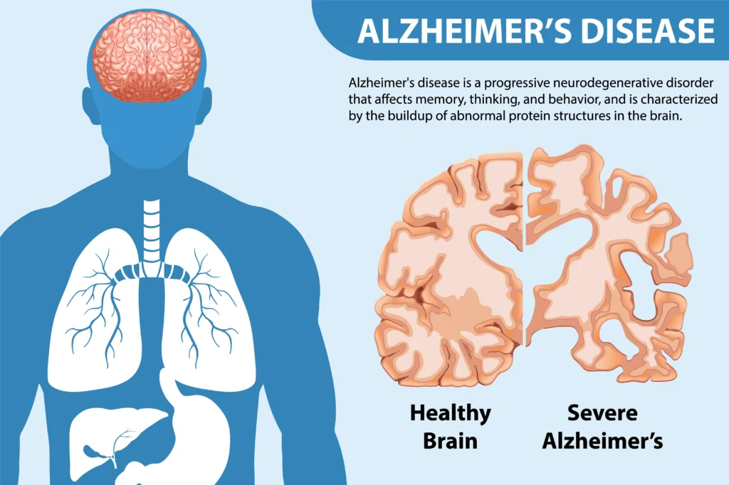 APOE4-related changes in brain blood vessels