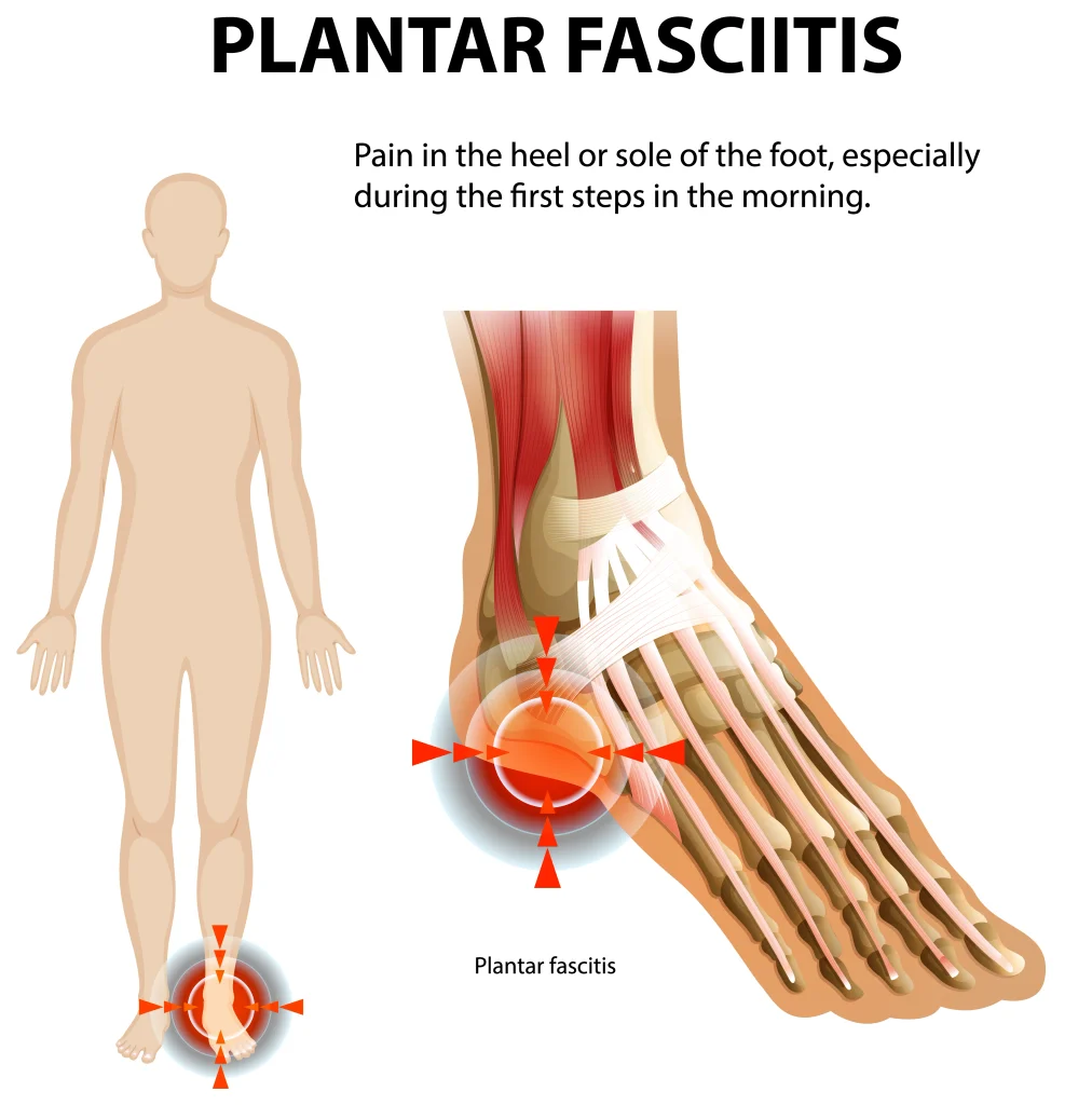 plantar fasciitis treatment