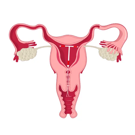 can exercise dislodge an IUD