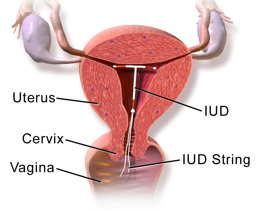 Healthcare professional discussing a contraceptive implant with a patient.