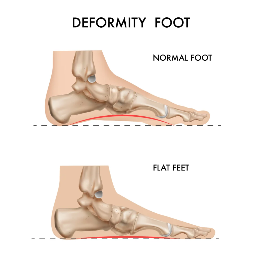 flat feet treatment