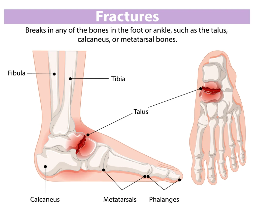 Stress fracture of the ankle