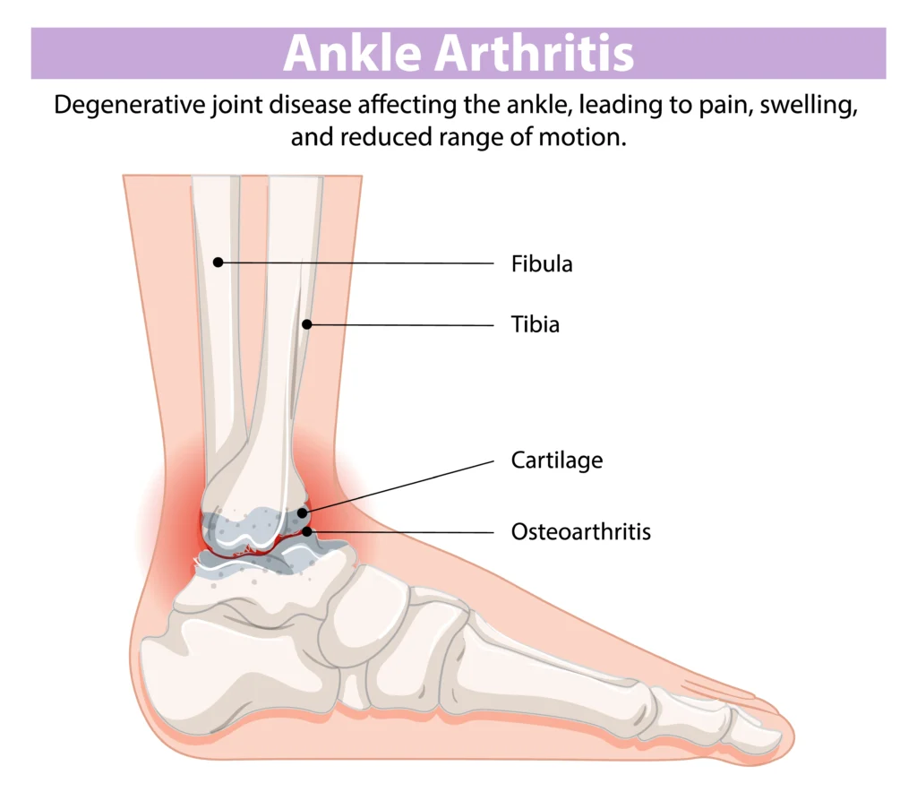 ankle arthritis symptoms