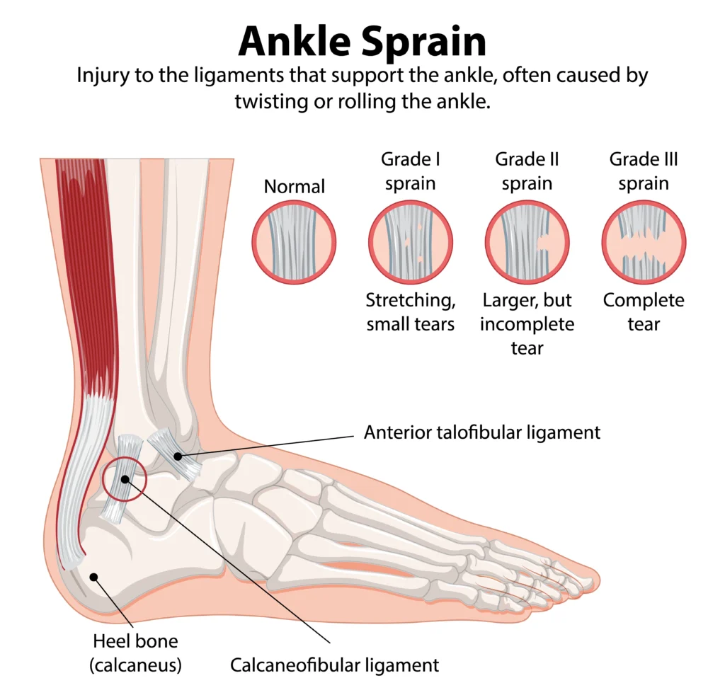 ankle pain 2 weeks after sprain