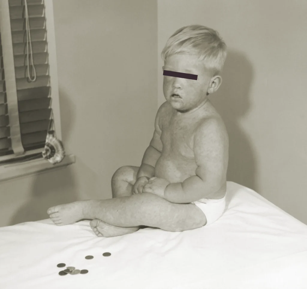 Characteristic measles rash on a child during the third day of infection.