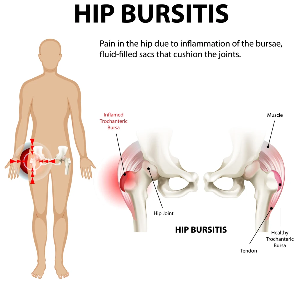 Ischial bursitis treatment