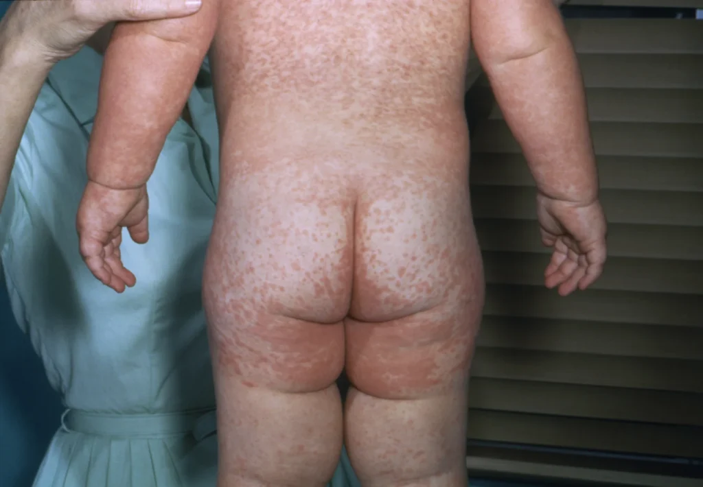Clinical photograph showing a measles-associated rash