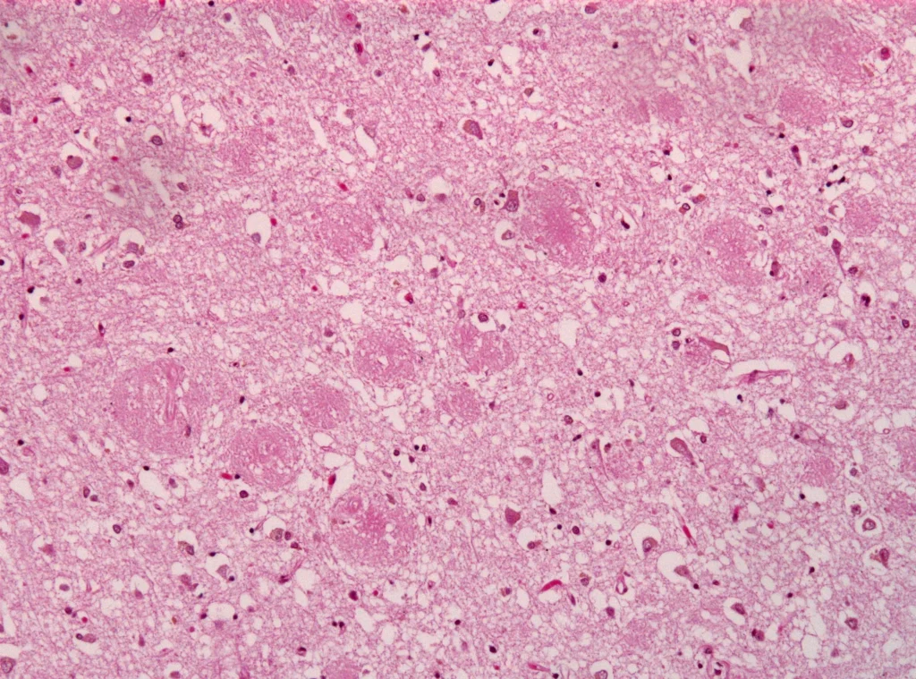 Microscopic brain tissue image showing amyloid plaques associated with Alzheimer's disease