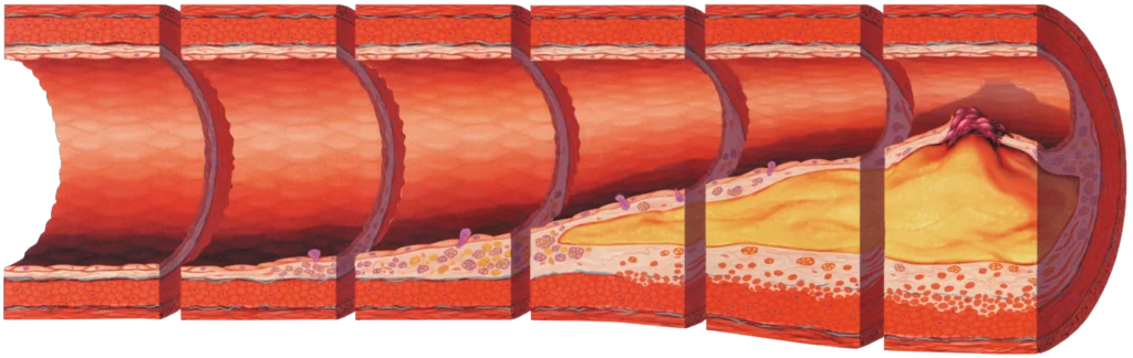 Medical illustration showing the progression of plaque buildup inside an artery