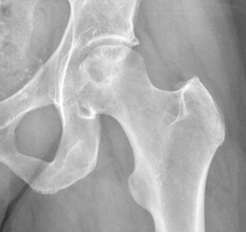 Avascular Necrosis of the Hip