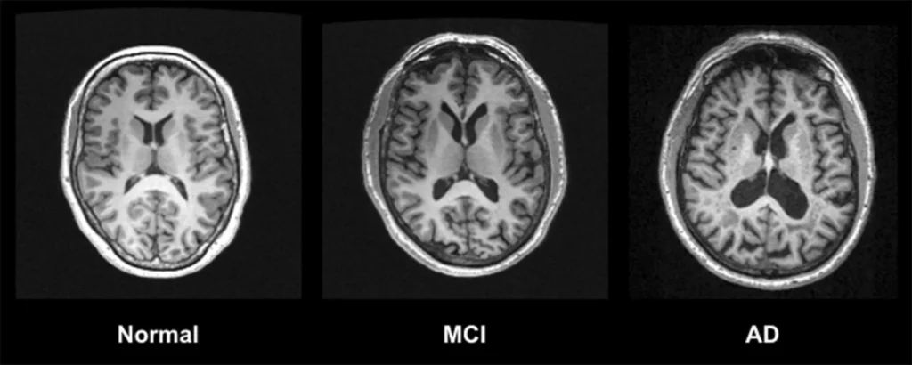 MRI comparison of control, mild cognitive impairment and Alzheimer’s disease brains.