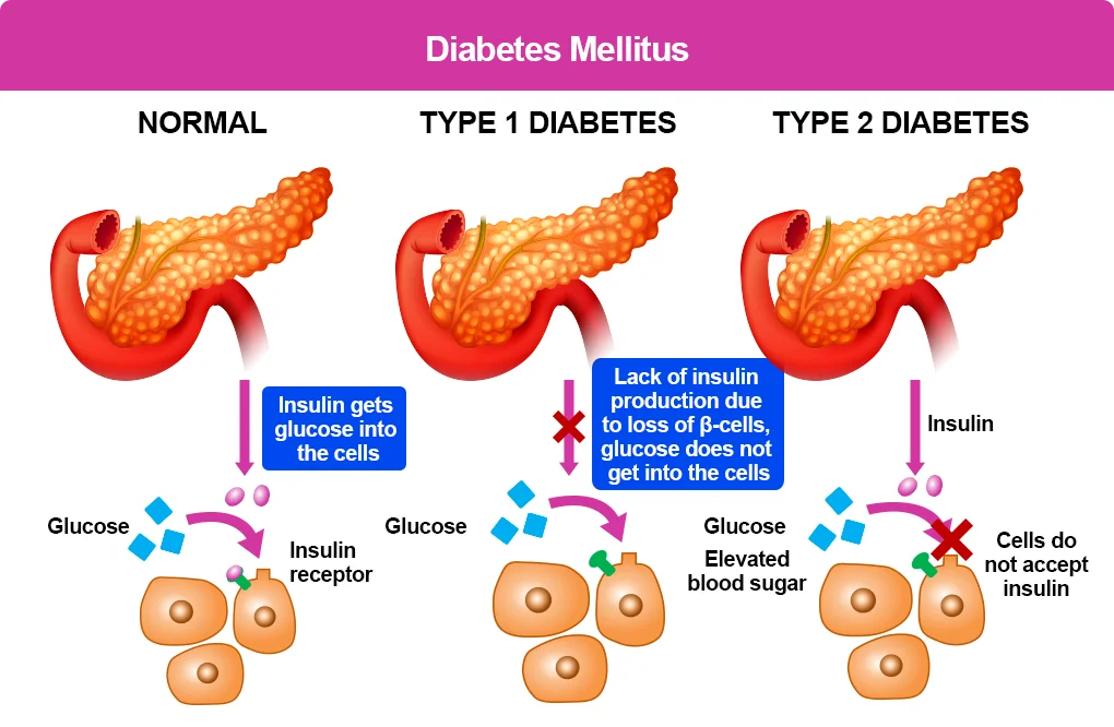 Illustration explaining diabetes mellitus.