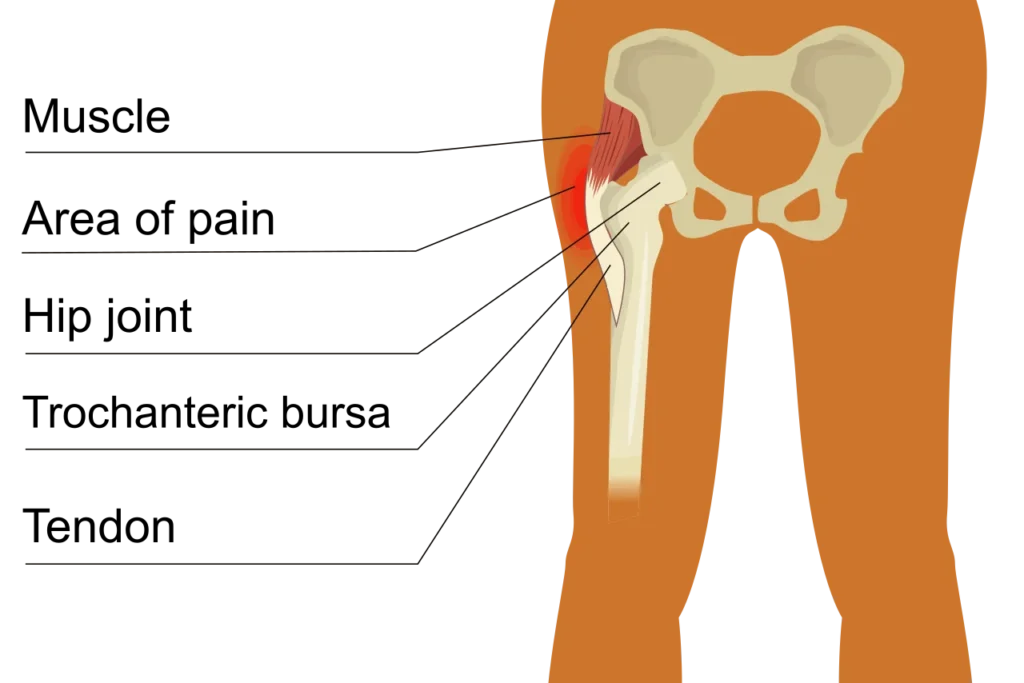 Medical illustration of greater trochanteric pain syndrome affecting the outer hip
