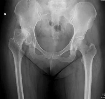 Hip dysplasia in adults