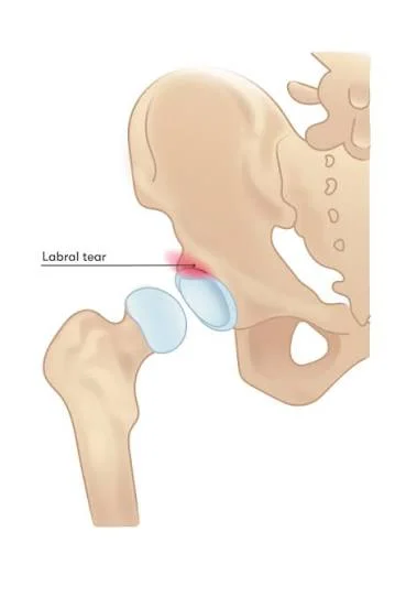 Hip labral tear