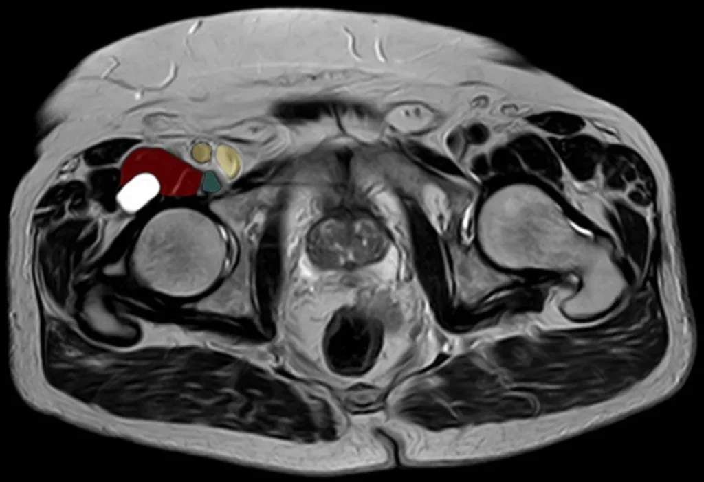 Iliopsoas bursitis treatment