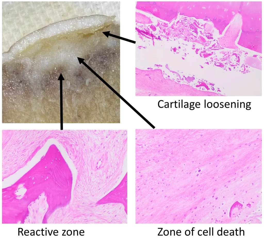 Femoral Head Osteonecrosis pathology