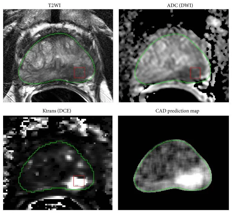 Multiparametric prostate MRI showing an algorithm-identified suspicious region