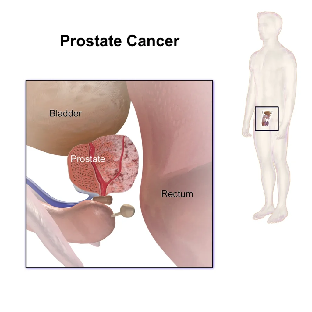 Medical illustration explaining prostate cancer anatomy