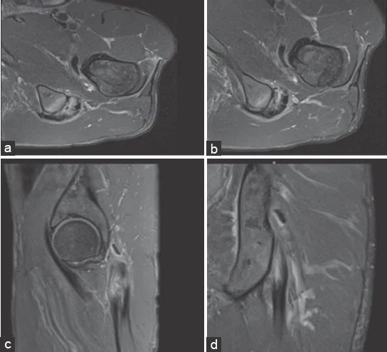 Proximal hamstring tendinopathy