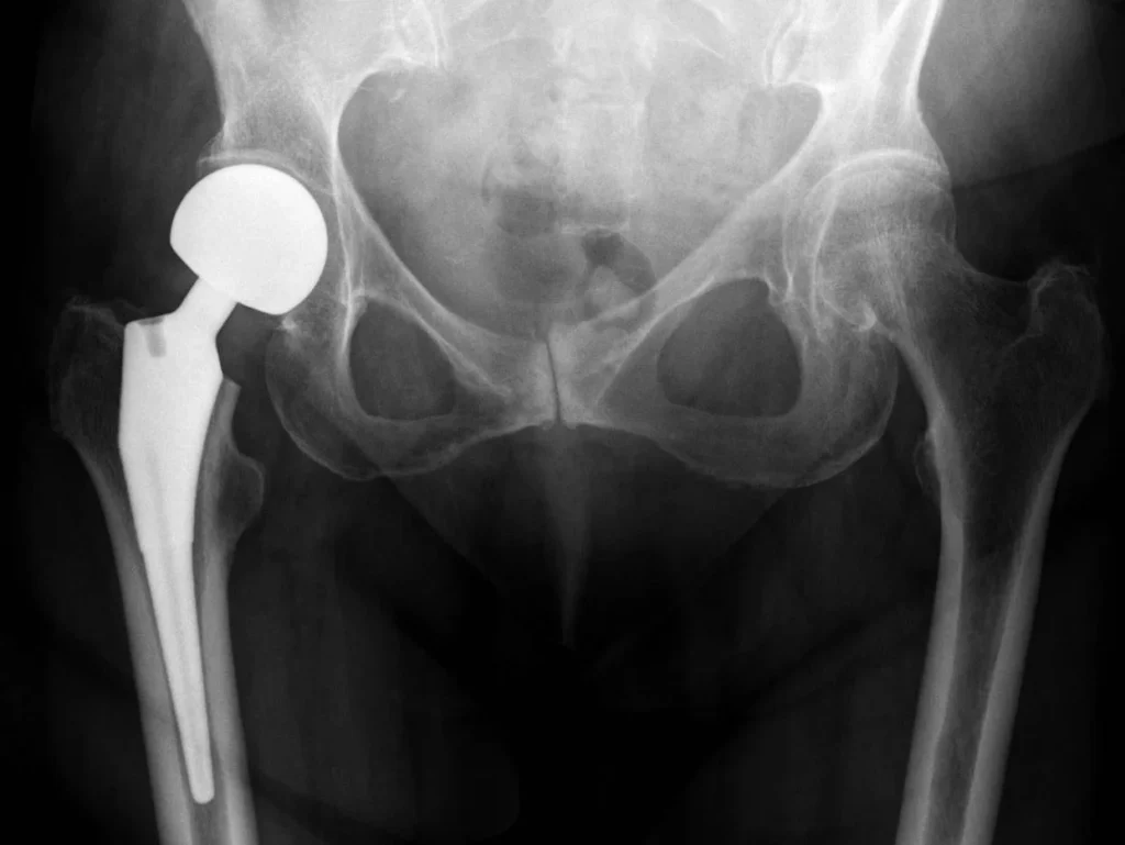 Hip Replacement Recovery Tips