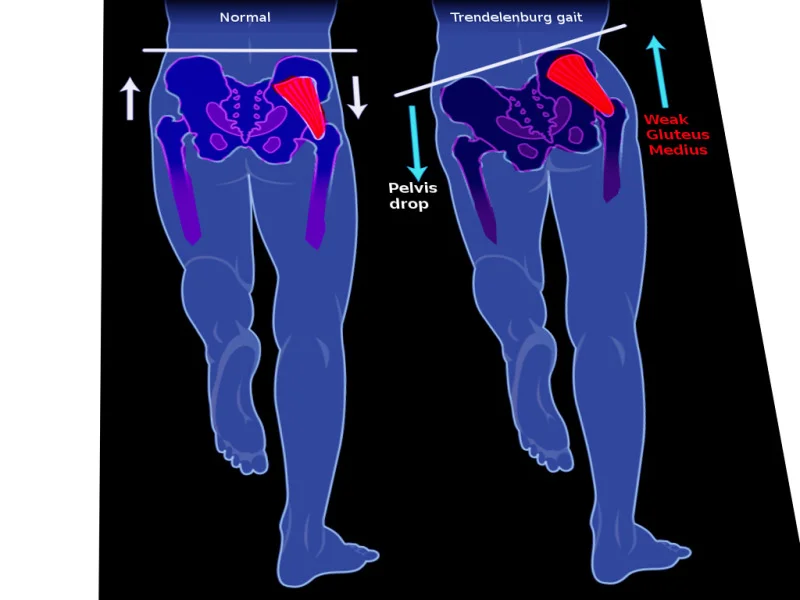 Illustration showing pelvic drop associated with a Trendelenburg gait due to hip abductor weakness