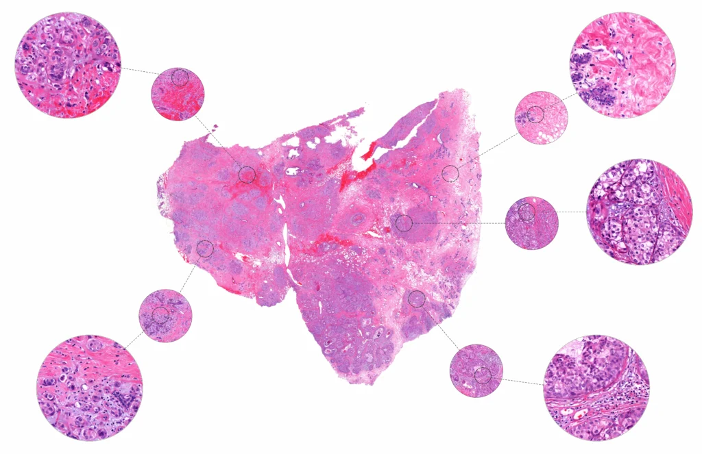 Breast tumour tissue examined using H&E staining at different magnifications