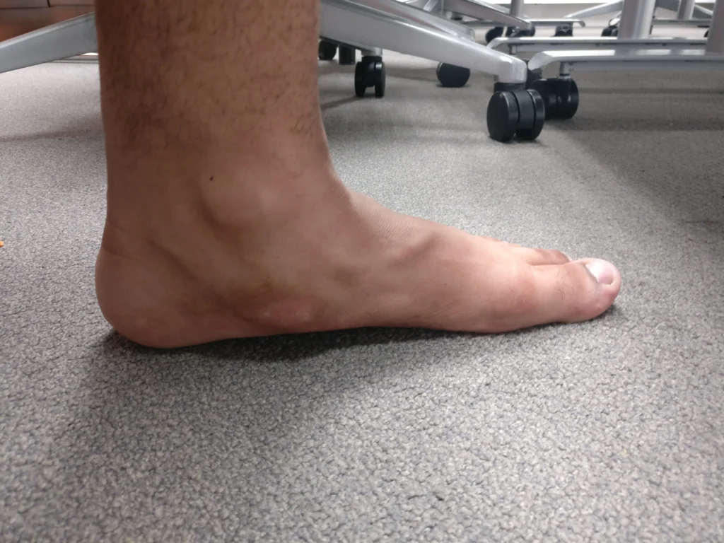 can accessory navicular cause ankle pain
