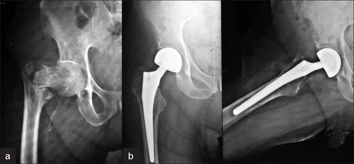 Femoral neck stress fracture