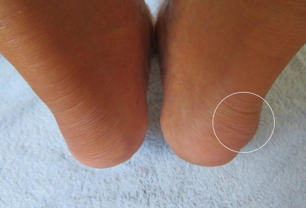 Haglund's syndrome treatment