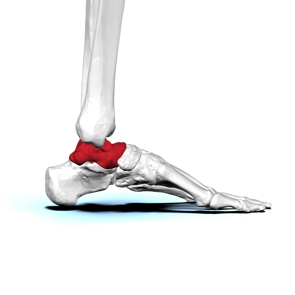 osteochondral lesion of the talus