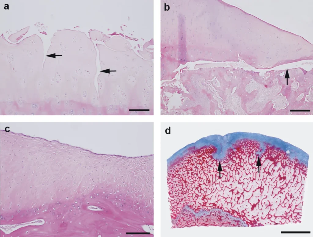 osteochondritis dissecans of ankle