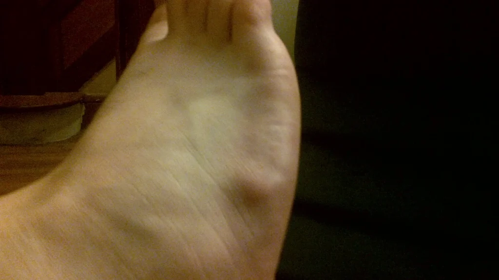 synovial cyst on ankle treatment